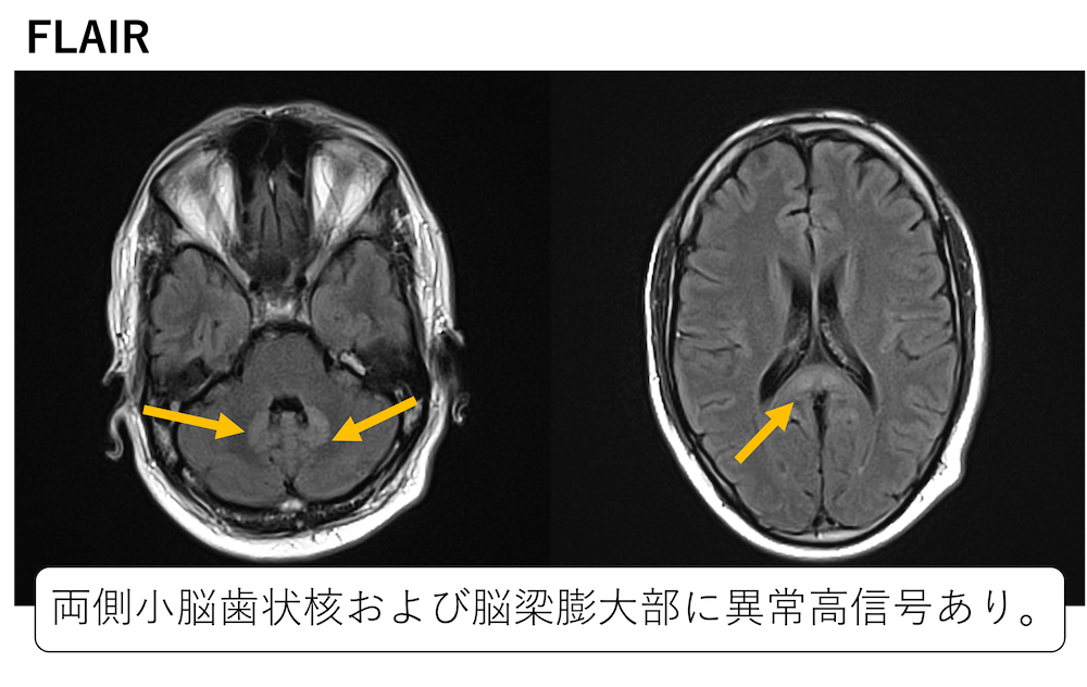 薬剤性脳症の原因薬剤と主な障害部位とMRI画像所見